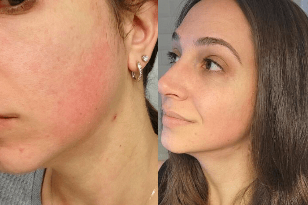 after only a week of The Balm, it has transformed not only my skin, but my confidence, and my life. - Cowbelle Skincare