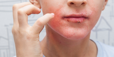 Eczema 101: Causes & Management