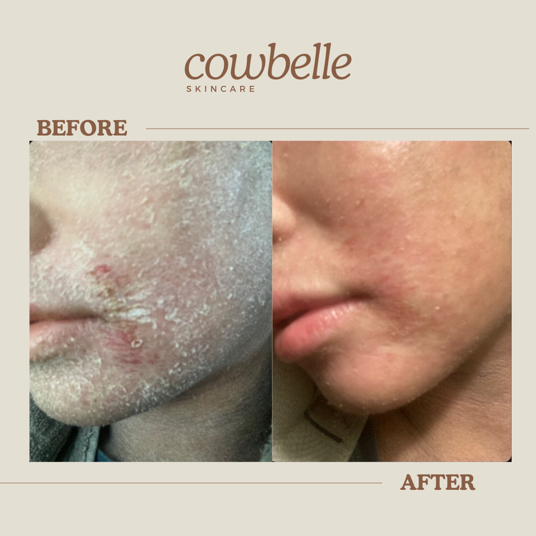 “Girl, What Is In Here? It’s Incredible!” — Liv’s TSW & Eczema Story with Cowbelle’s Tallow Balm