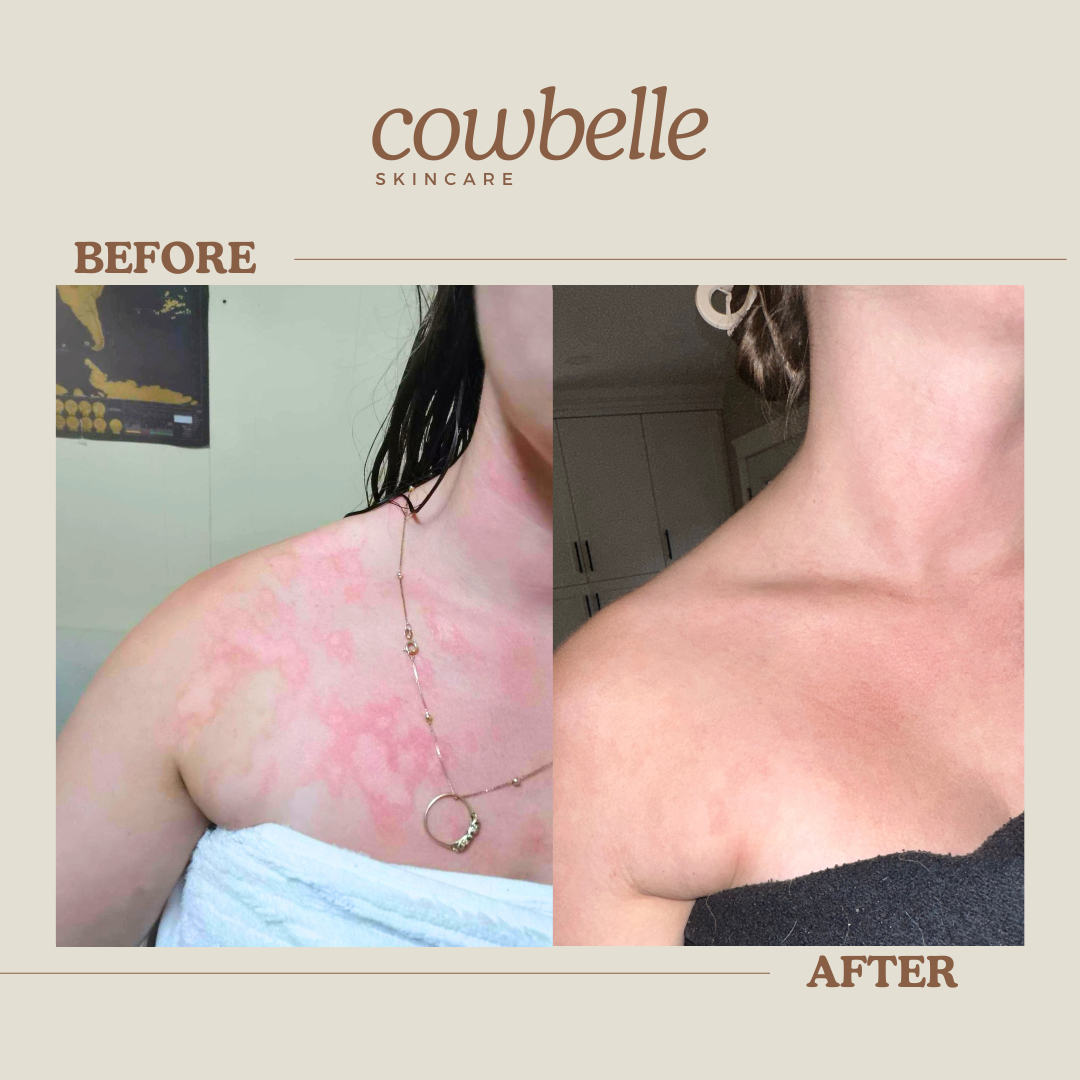 From Skeptic to Believer: How The Balm Helped Heal My Sister’s Eczema