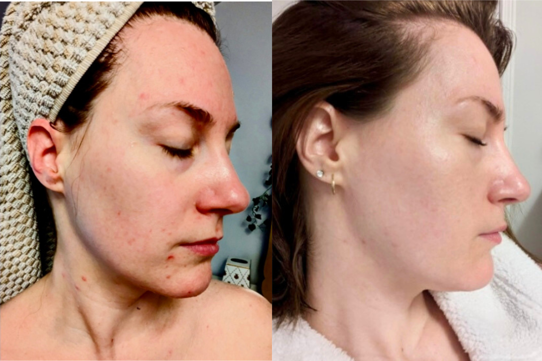 Simply Amazing! I cannot put into words how much my skin has transformed!