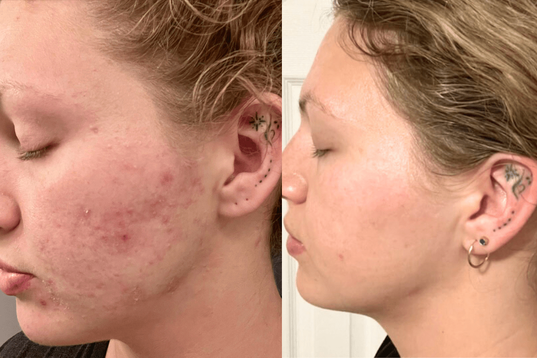 after 2-weeks I saw results that would have taken accutane months - Cowbelle Skincare
