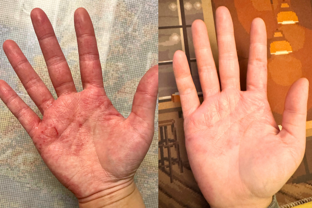 I can see a huge difference in my dyshidrotic eczema that has spread from my fingers to my palms on both of my hands.