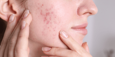 Does Tallow Really Clog Pores? - Cowbelle Skincare