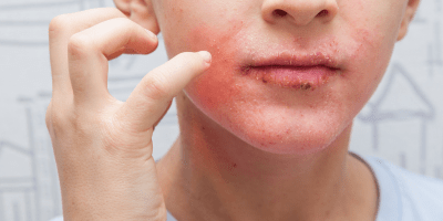 Eczema 101: Causes & Management - Cowbelle Skincare