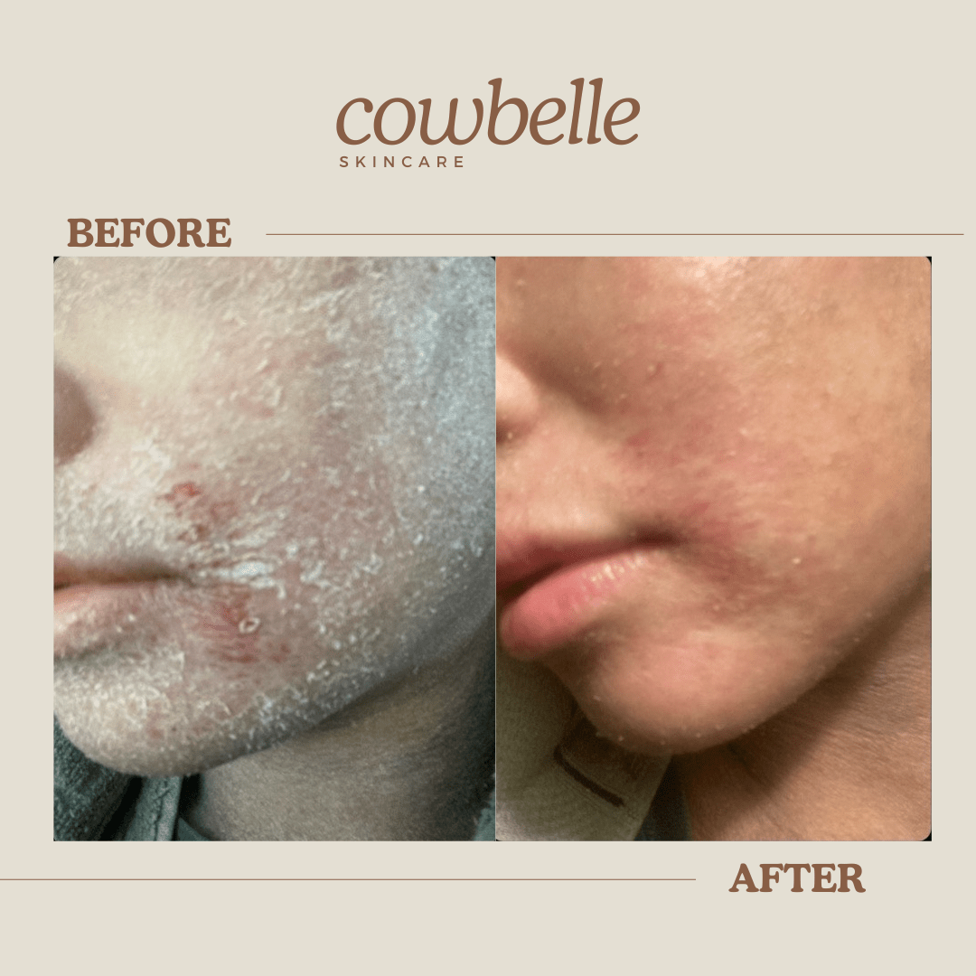 “Girl, What Is In Here? It’s Incredible!” — Liv’s TSW & Eczema Story with Cowbelle’s Tallow Balm - Cowbelle Skincare