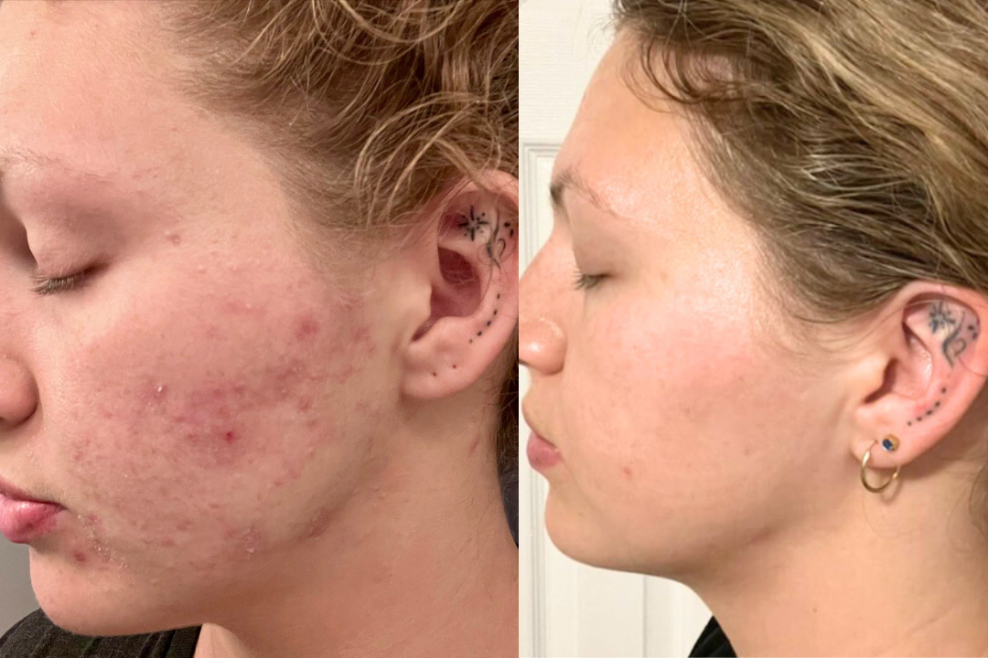 after 2-weeks I saw results that would have taken accutane months